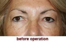 plastic-surgery-blepharoplasty